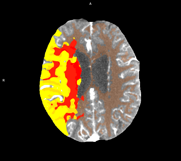 MRI-Bild des Gehirns mit roten und gelben Bereichen, die unterschiedliche Aktivitätsniveaus anzeigen.